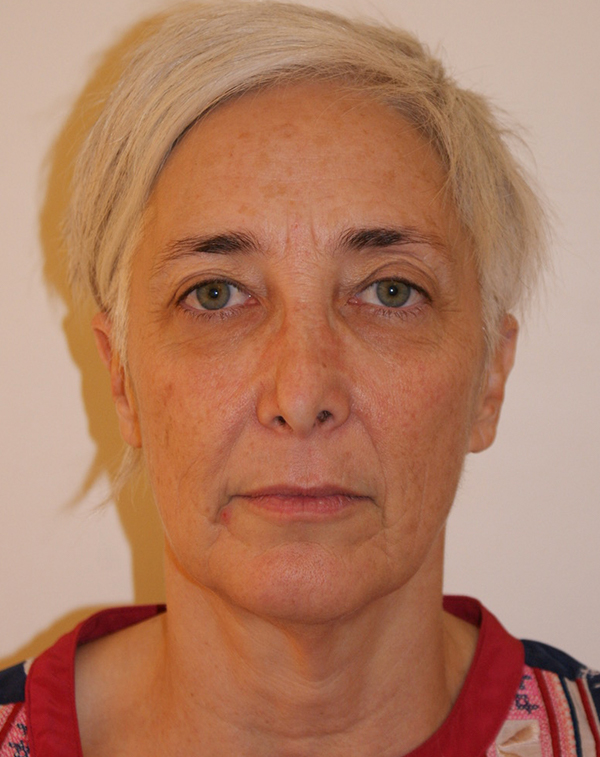 Face and Neck Lift before and after - before