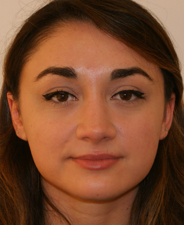 Rhinoplasty before and after - after
