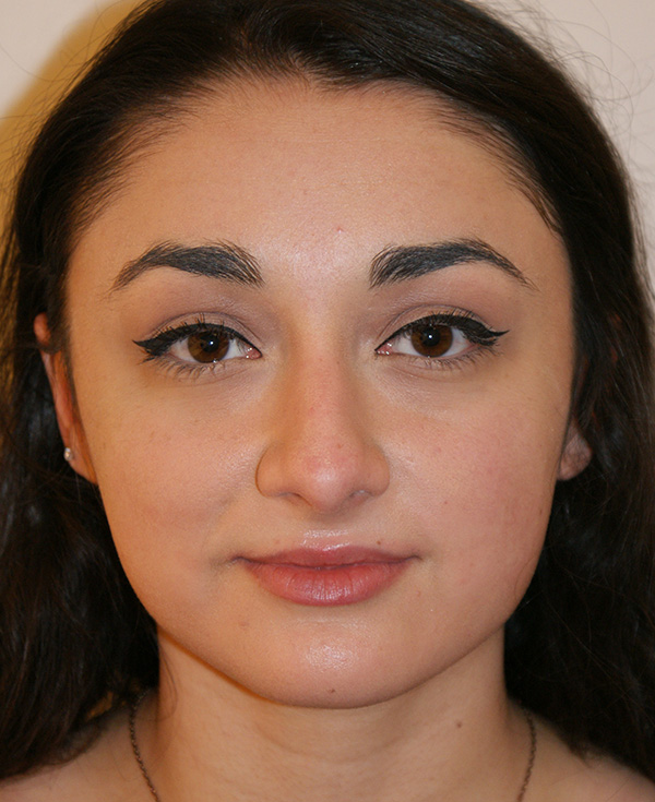 Rhinoplasty before and after - before