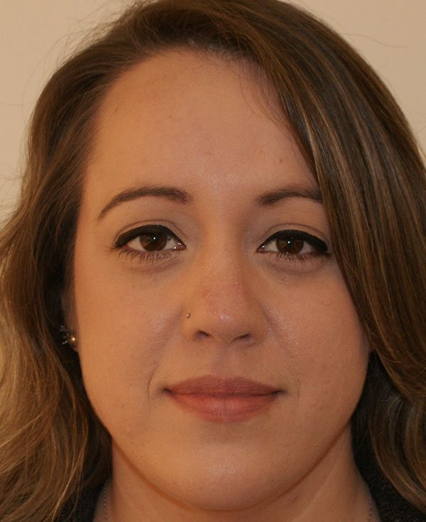 Rhinoplasty before and after - after