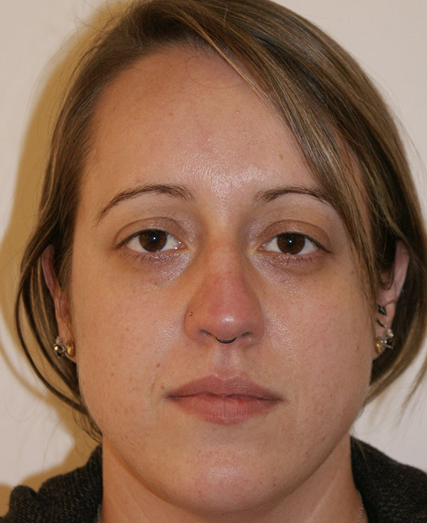 Rhinoplasty before and after - before