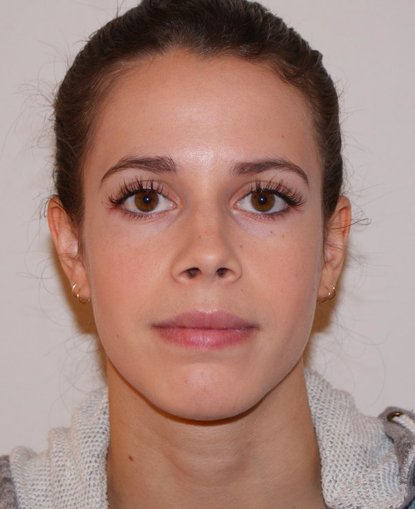 Rhinoplasty before and after - after