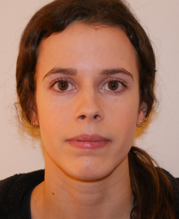 Rhinoplasty before and after - before