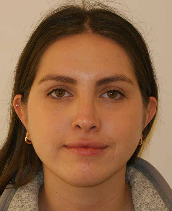 Rhinoplasty before and after - after