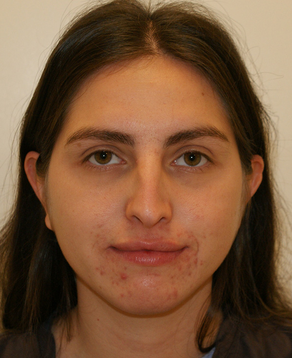 Rhinoplasty before and after - before