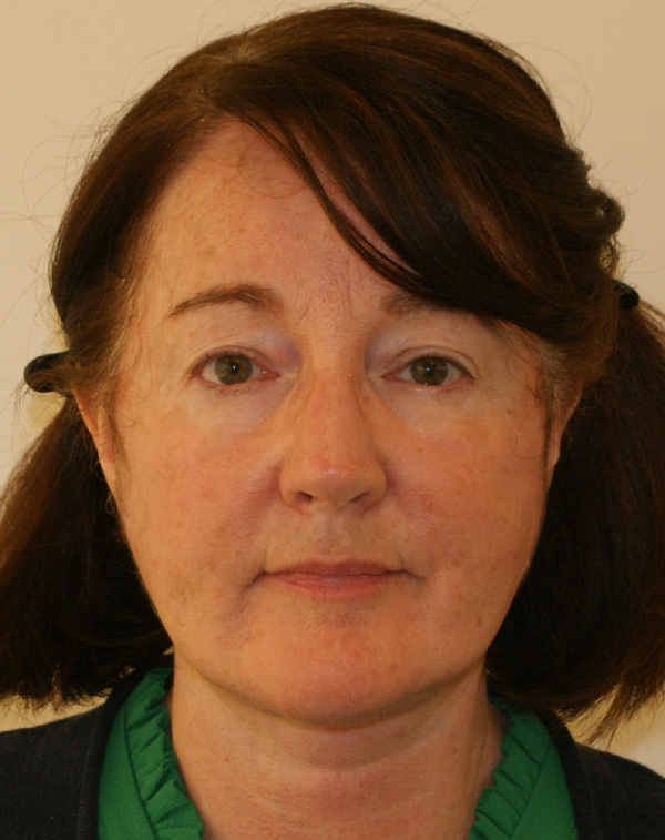 Face and Neck Lift before and after - after