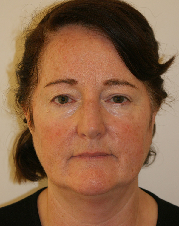 Face and Neck Lift before and after - before