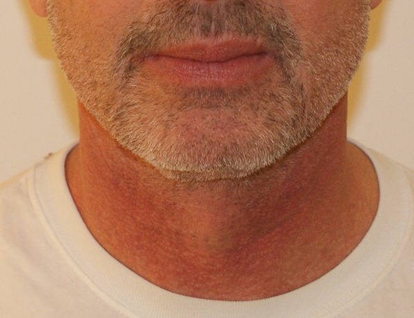 Short Scar Neck Lift before and after - after