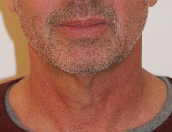 Short Scar Neck Lift before and after - before