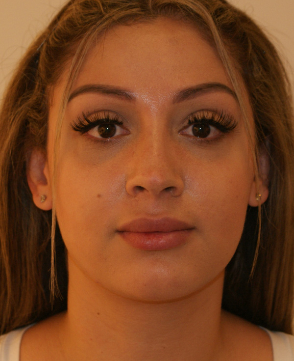 Rhinoplasty before and after - after