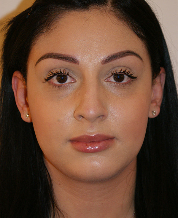 Rhinoplasty before and after - before