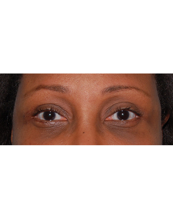 Facial Fat Transfer before and after - after