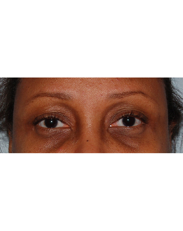Facial Fat Transfer before and after - before
