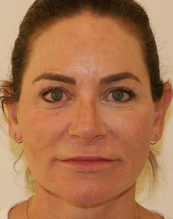 Face and Neck Lift before and after - after