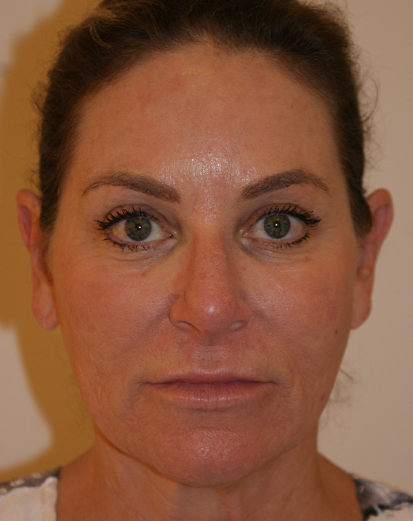 Face and Neck Lift before and after - before