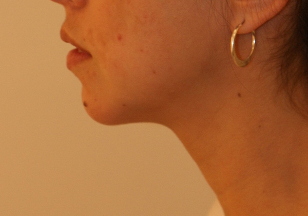 Chin Implants before and after - after