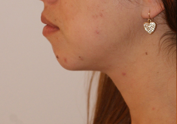 Chin Implants before and after - before