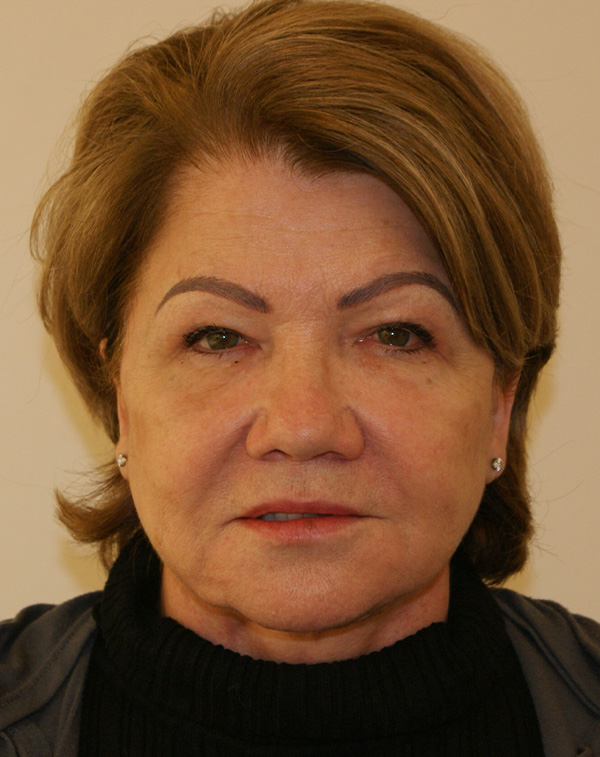 Face and Neck Lift before and after - after