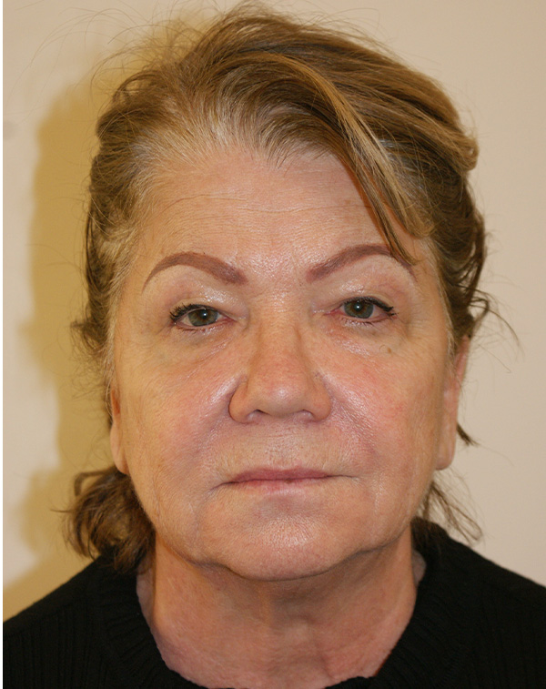 Face and Neck Lift before and after - before
