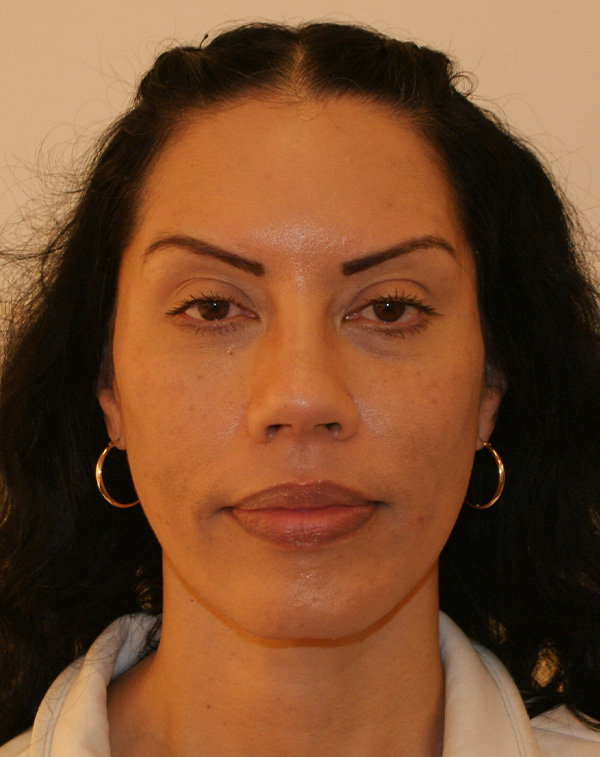 Face and Neck Lift before and after - after