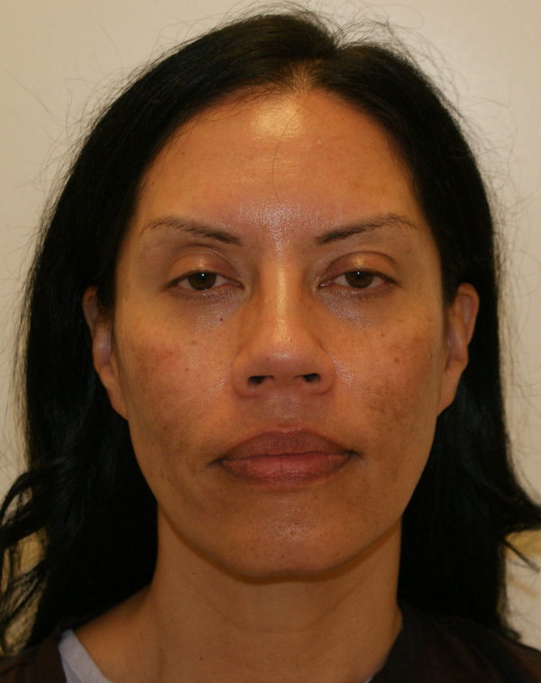 Face and Neck Lift before and after - before