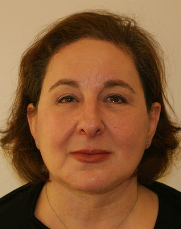 Face and Neck Lift before and after - after