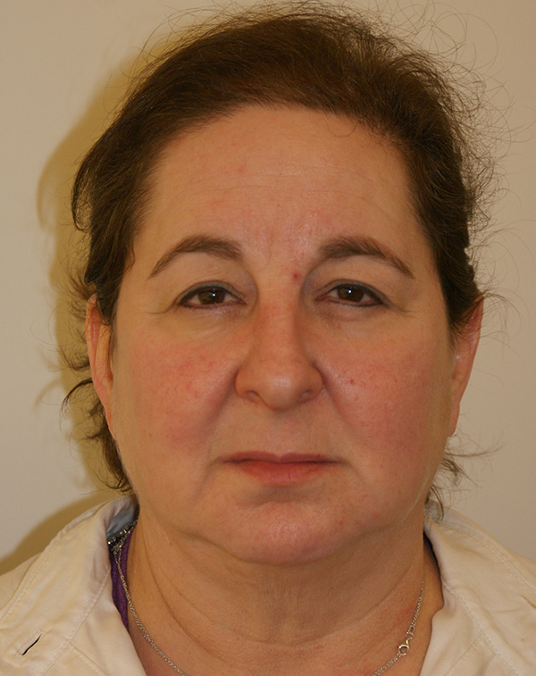 Face and Neck Lift before and after - before