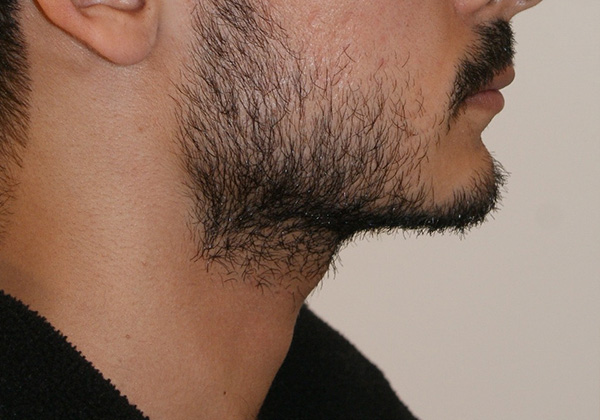 Chin Implants before and after - after