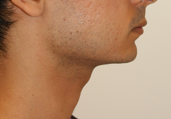 Chin Implants before and after - before