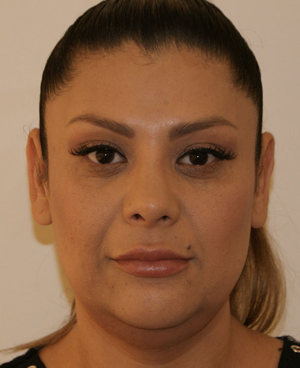 Rhinoplasty before and after - after