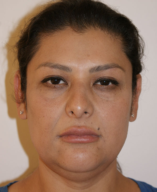 Rhinoplasty before and after - before