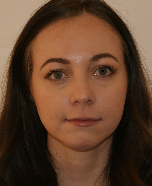 Rhinoplasty before and after - after