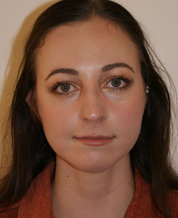Rhinoplasty before and after - before
