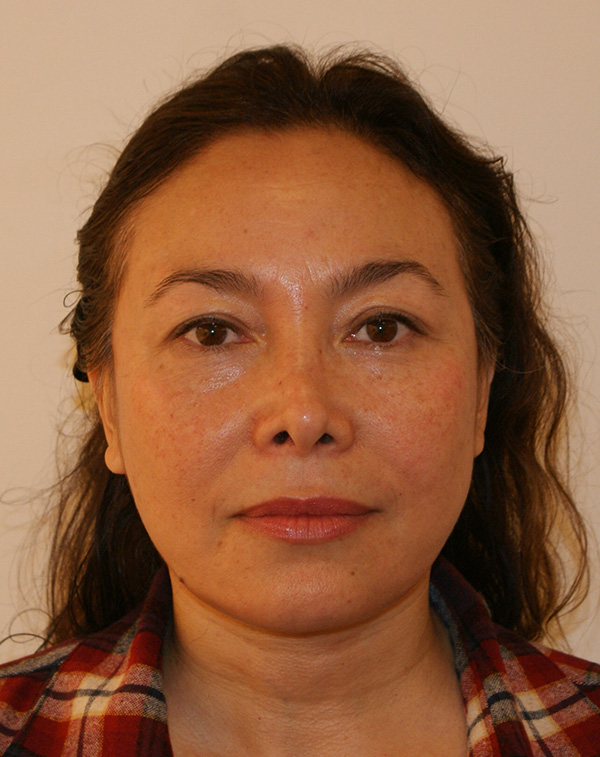 Face and Neck Lift before and after - after