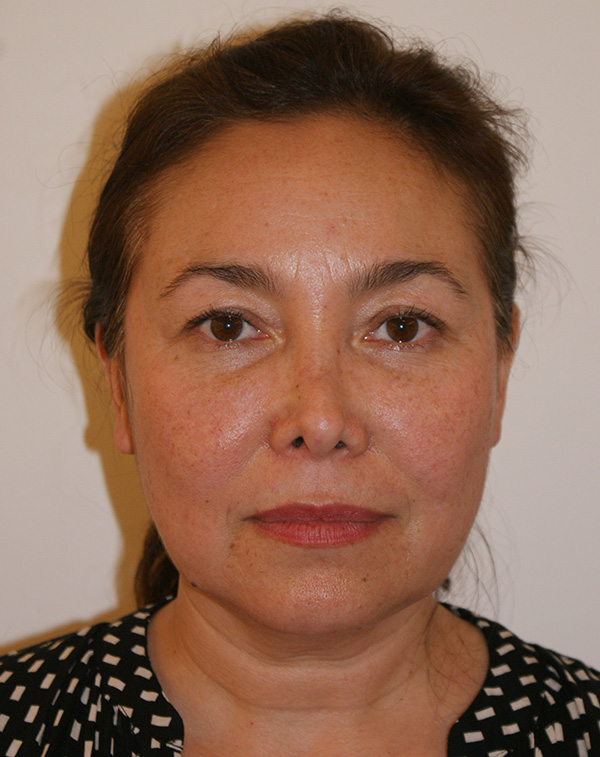 Face and Neck Lift before and after - before