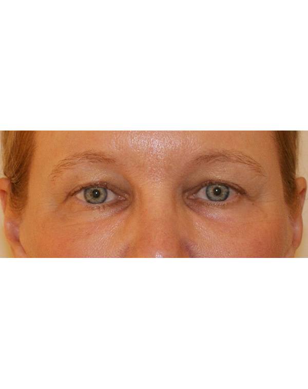 Facial Fat Transfer before and after - after