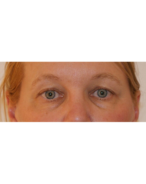 Facial Fat Transfer before and after - before