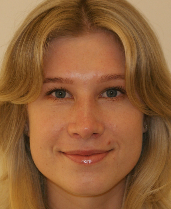 Rhinoplasty before and after - after