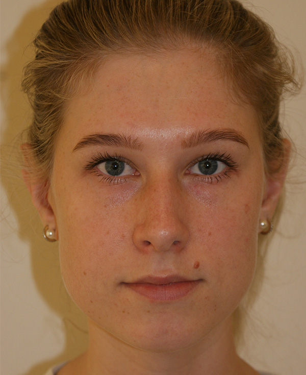 Rhinoplasty before and after - before