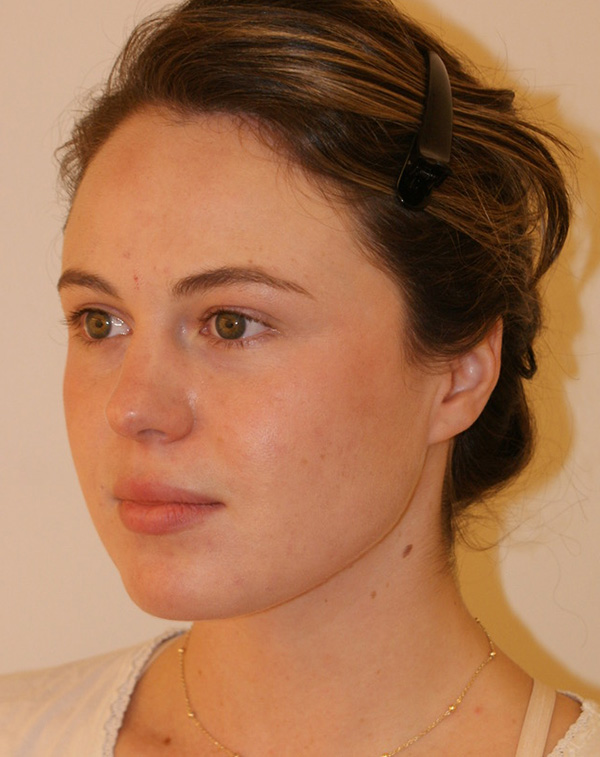 Face and Neck Lift before and after - after