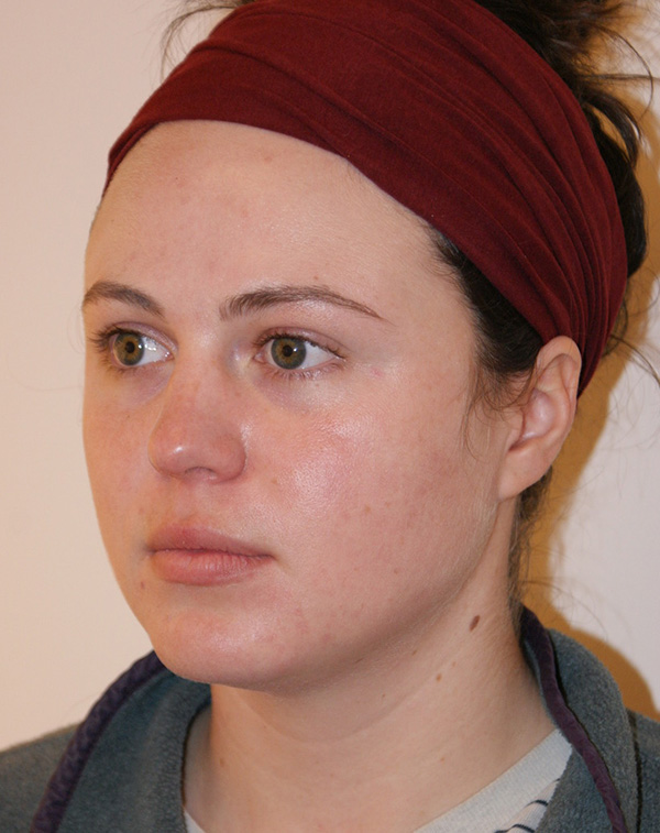 Face and Neck Lift before and after - before