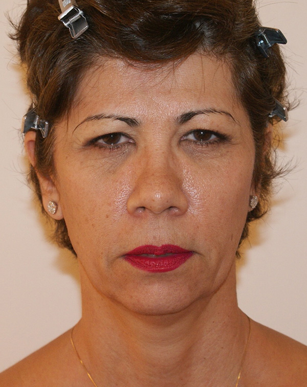 Face and Neck Lift before and after - before