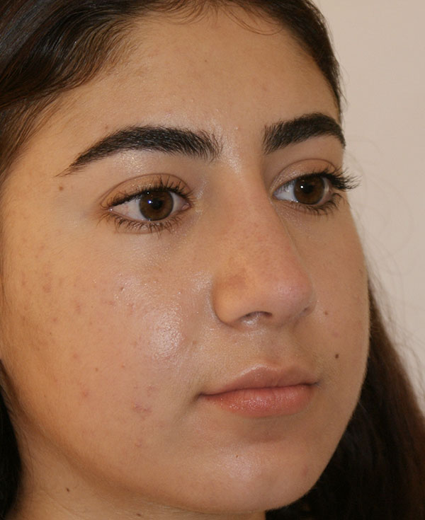 Rhinoplasty before and after - after