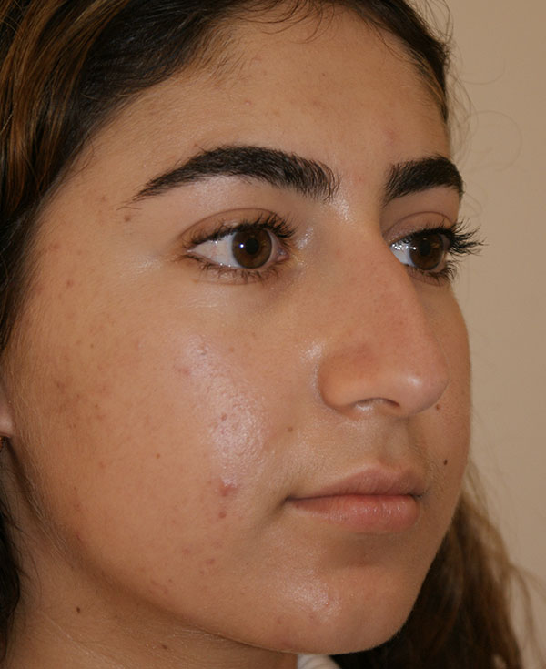 Rhinoplasty before and after - before
