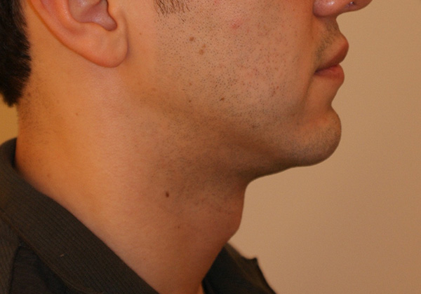 Chin Implants before and after - after