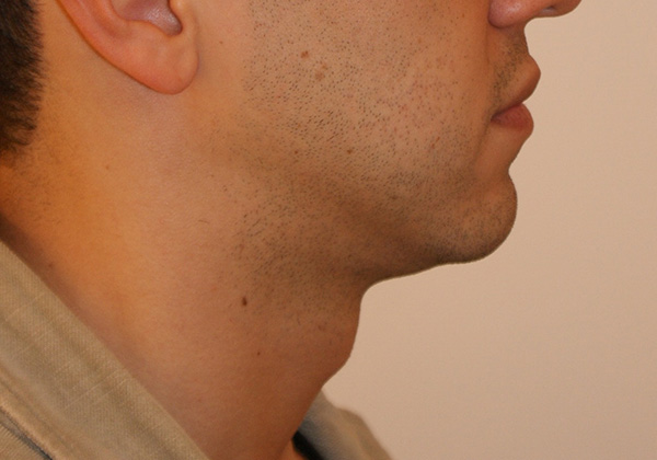 Chin Implants before and after - before