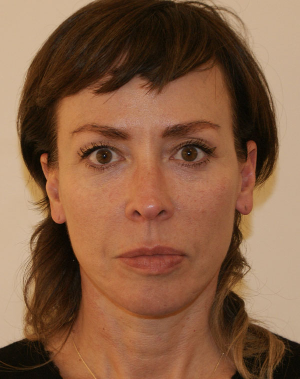 Face and Neck Lift before and after - after