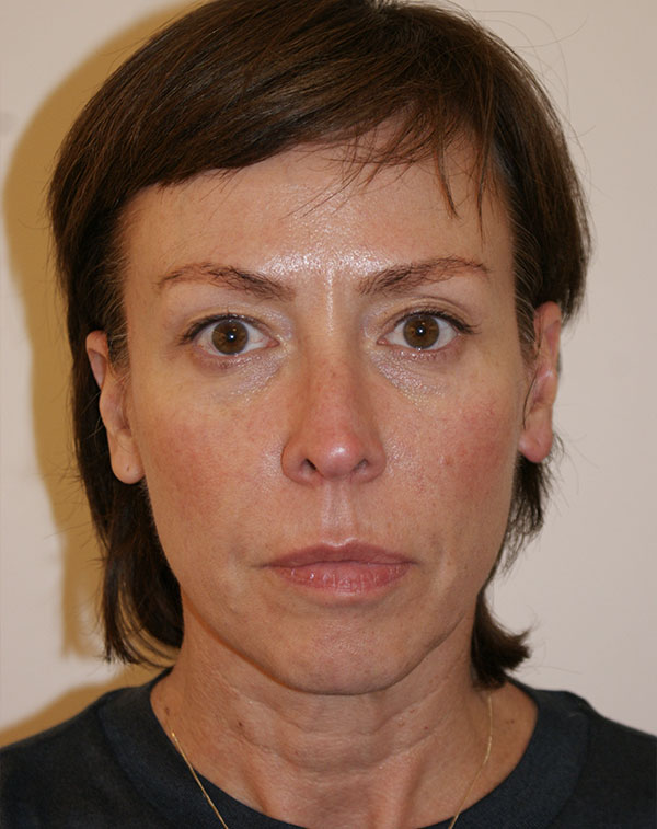 Face and Neck Lift before and after - before