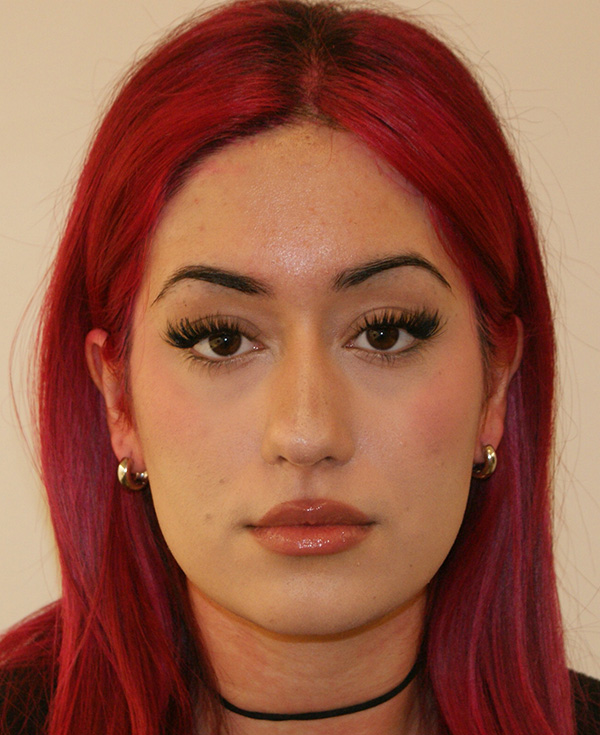Rhinoplasty before and after - after