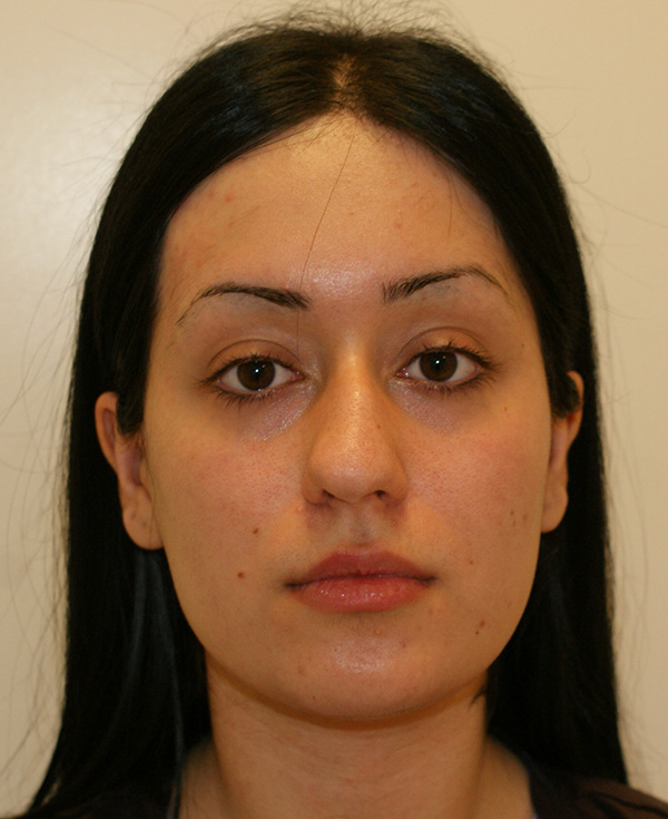 Rhinoplasty before and after - before